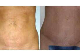 Abdominoplasty