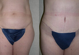 Abdominoplasty