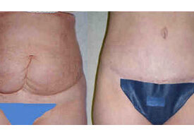 Abdominoplasty