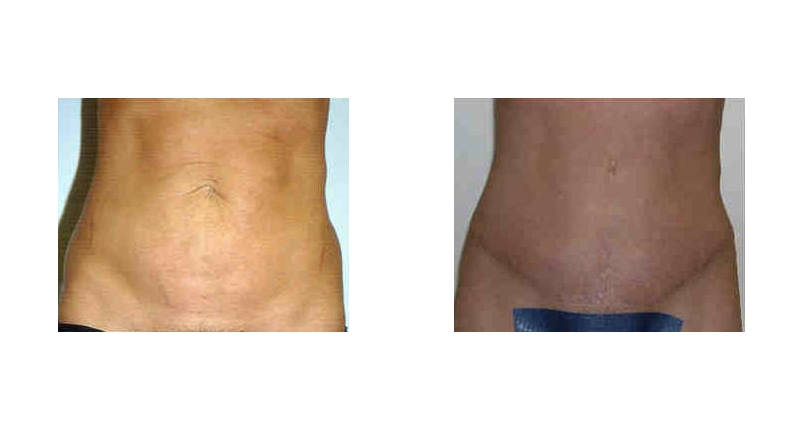 Abdominoplasty width='800