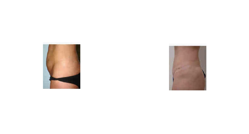 Abdominoplasty width='800