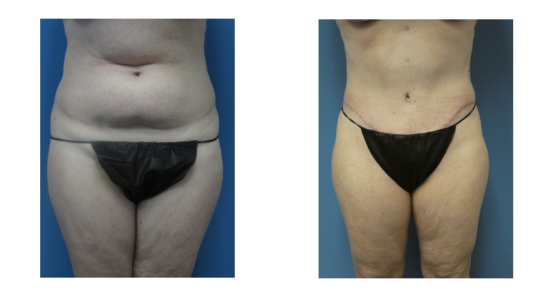 Abdominoplasty width='800