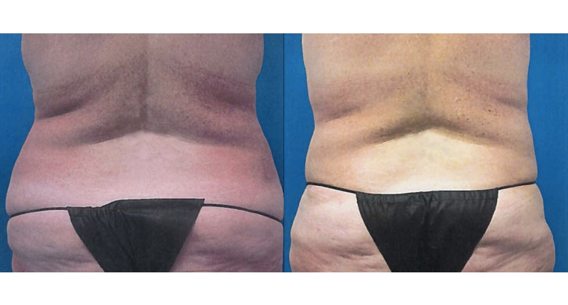 Abdominoplasty width='800