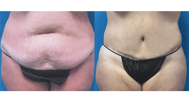 Abdominoplasty width='800