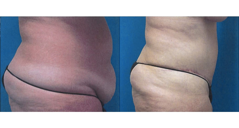 Abdominoplasty width='800