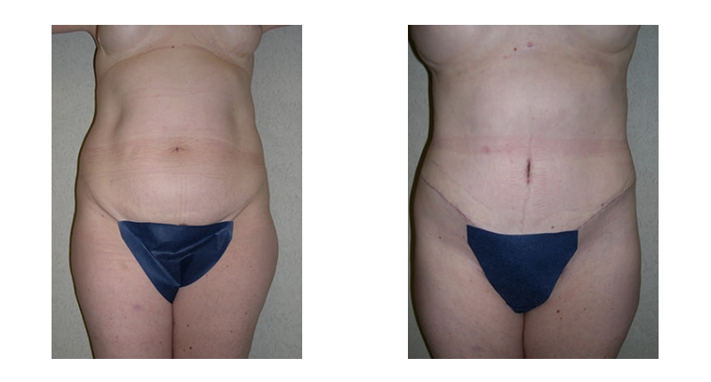 Abdominoplasty width='800