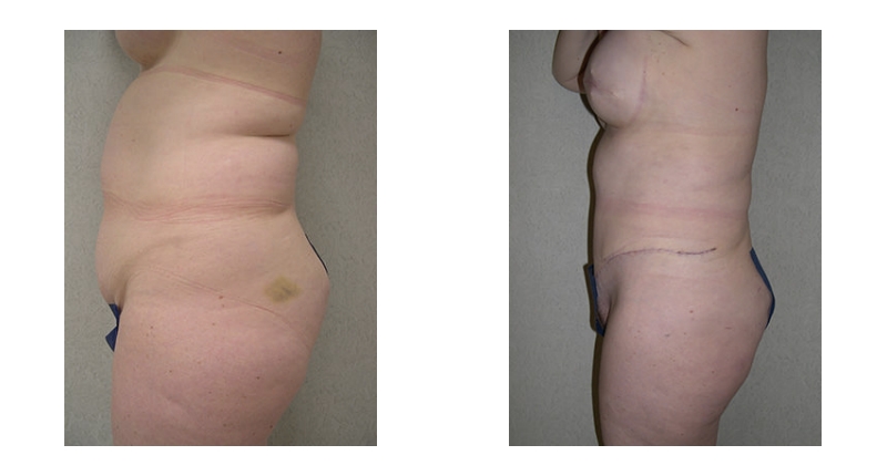 Abdominoplasty width='800