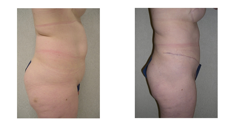 Abdominoplasty width='800