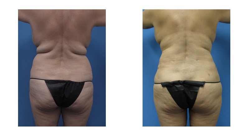 Abdominoplasty width='800