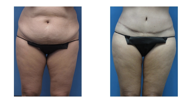 Abdominoplasty width='800
