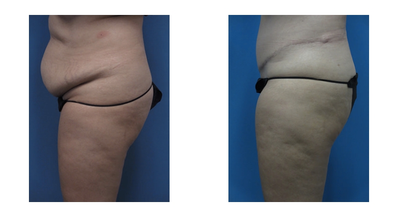 Abdominoplasty width='800
