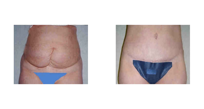 Abdominoplasty width='800