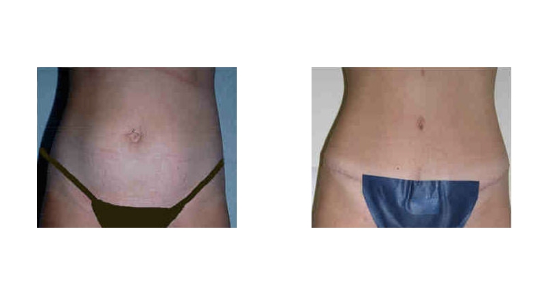 Abdominoplasty width='800