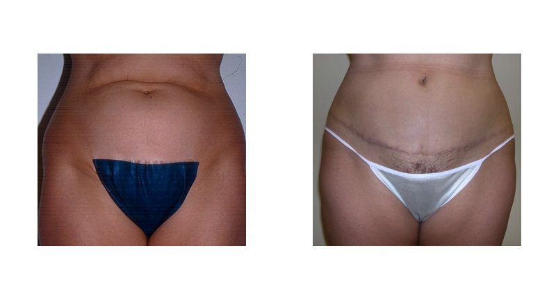 Abdominoplasty width='800