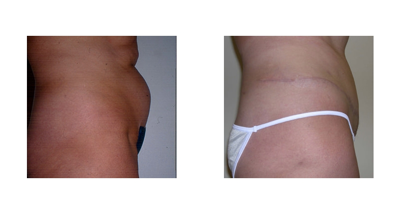 Abdominoplasty width='800