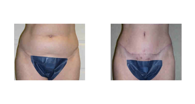 Abdominoplasty width='800
