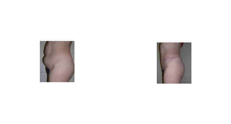 Abdominoplasty width='800