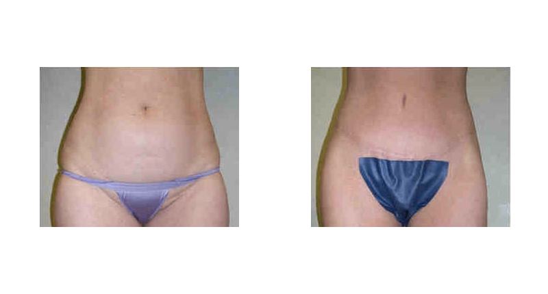 Abdominoplasty width='800