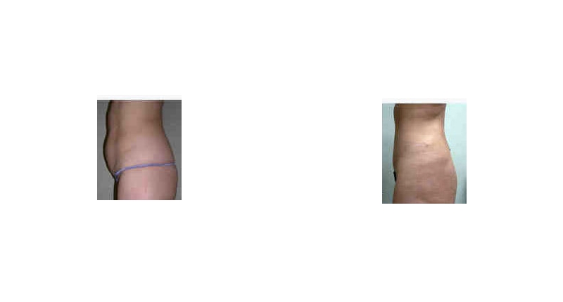 Abdominoplasty width='800