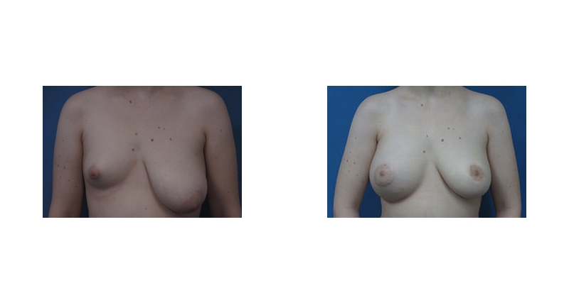 Breast Augmentation width='800