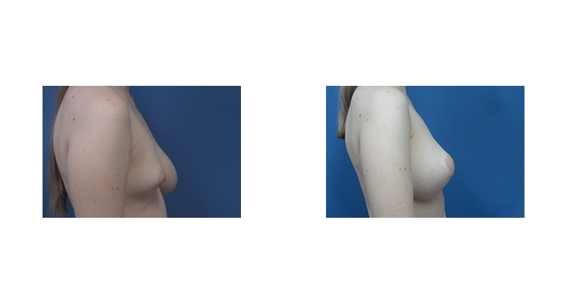 Breast Augmentation width='800