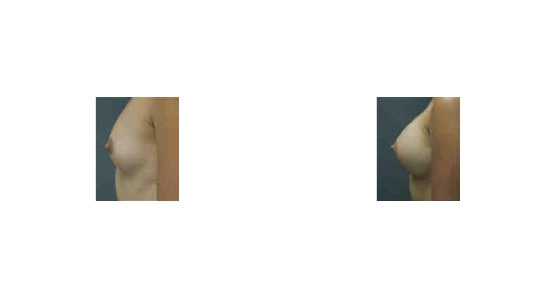 Breast Augmentation width='800