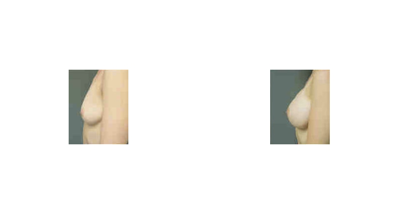 Breast Augmentation width='800