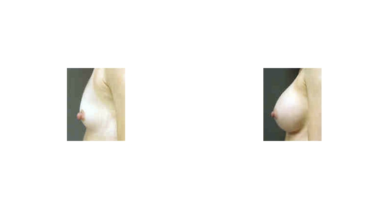 Breast Augmentation width='800