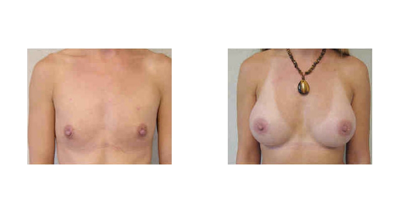 Breast Augmentation width='800