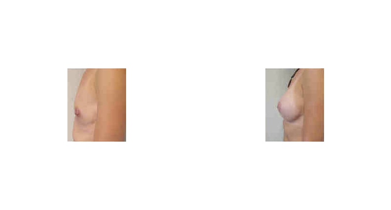 Breast Augmentation width='800