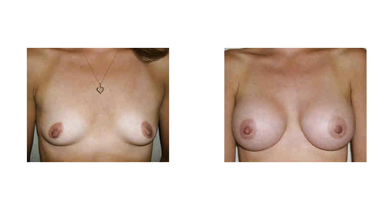 Breast Augmentation width='800