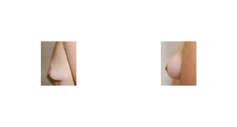 Breast Augmentation width='800