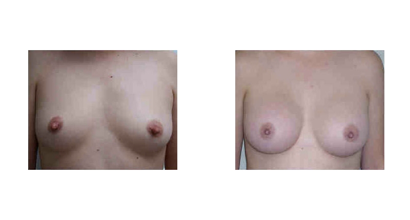 Breast Augmentation width='800