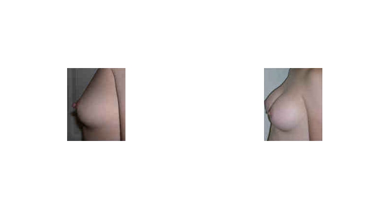 Breast Augmentation width='800