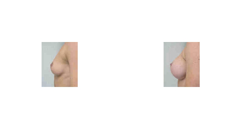 Breast Augmentation width='800