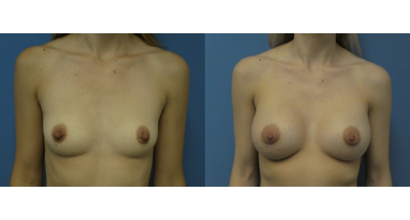 Breast Augmentation width='800