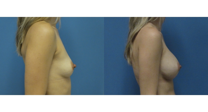 Breast Augmentation width='800