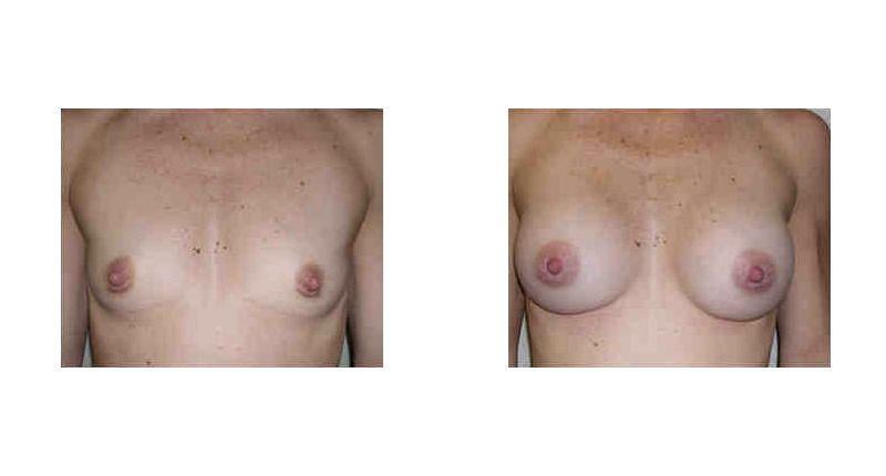 Breast Augmentation width='800