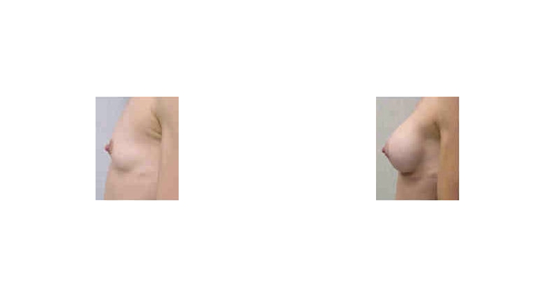 Breast Augmentation width='800