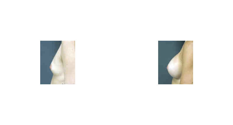 Breast Augmentation width='800