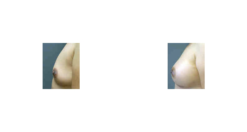 Breast Augmentation width='800