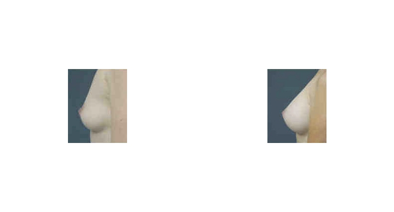 Breast Augmentation width='800