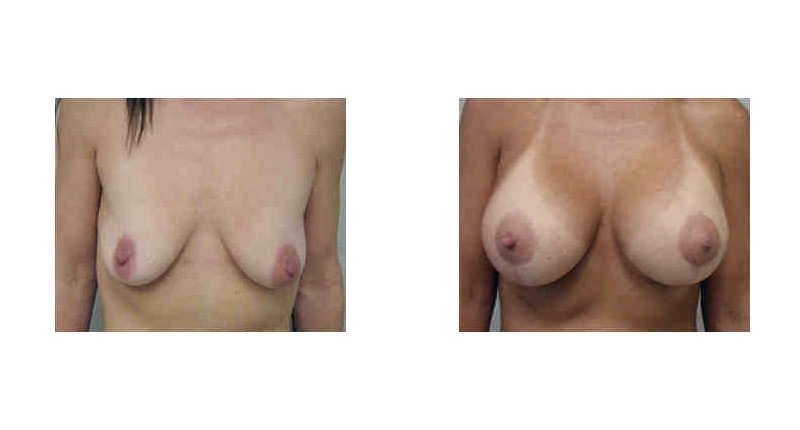 Breast Augmentation width='800