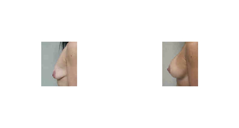 Breast Augmentation width='800