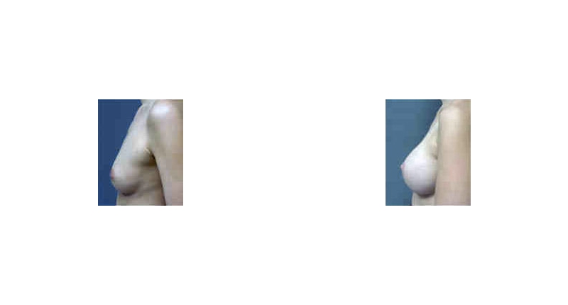 Breast Augmentation width='800