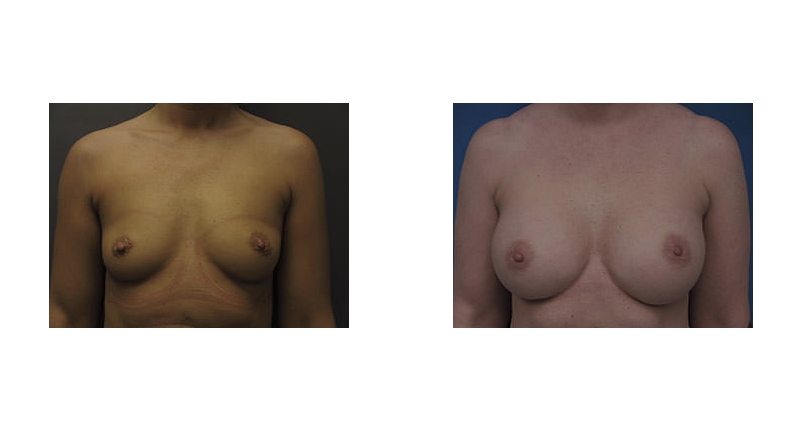 Breast Augmentation width='800