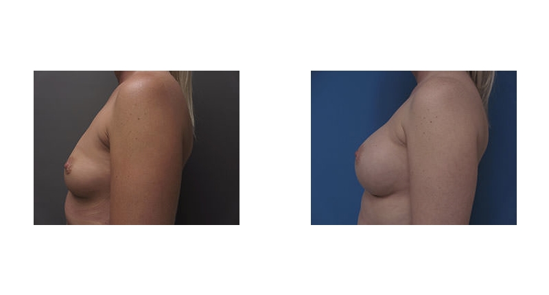 Breast Augmentation width='800