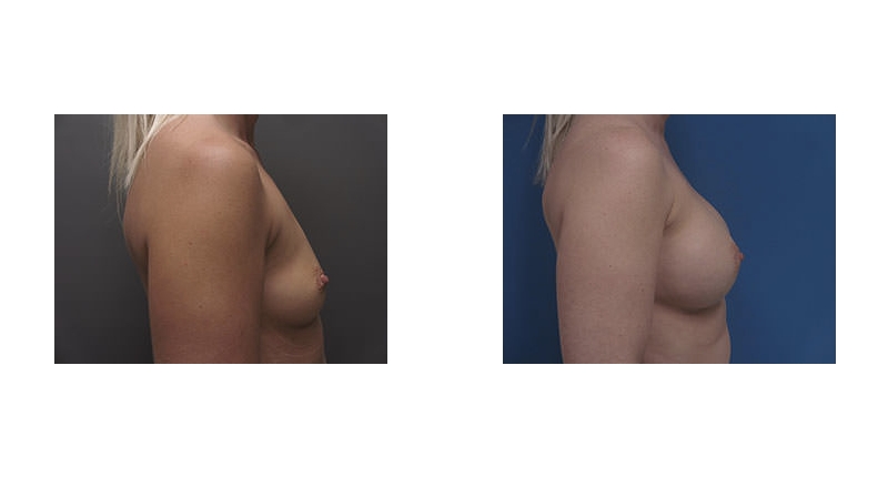 Breast Augmentation width='800