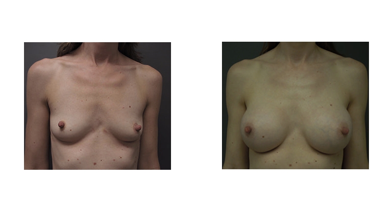 Breast Augmentation width='800