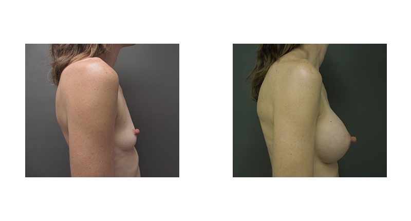 Breast Augmentation width='800